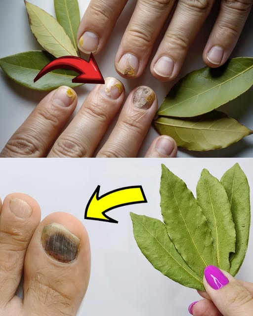 Get rid of nail fungus with a natural remedy for less than 50 cents: the little-known power of bay leaves