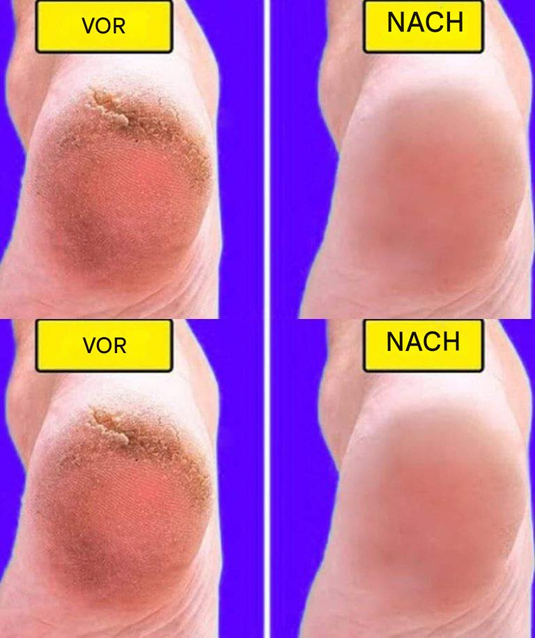 Homemade recipe for soft and smooth feet in 10 minutes👇👇